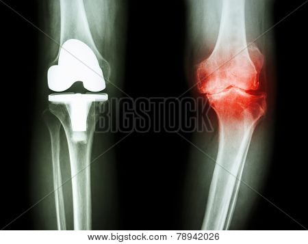 X-ray Knee Of Osteoarthritis Knee Patient And Artificial Joint