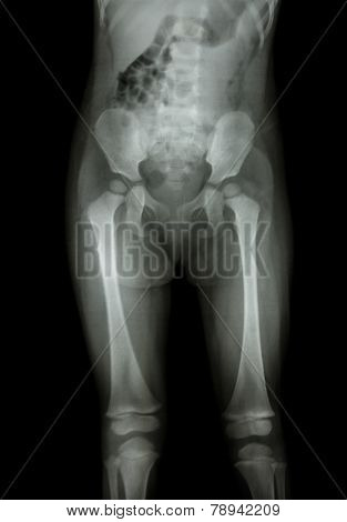 Film X-ray Normal Body Of Child (abdomen,buttock,thigh,knee)