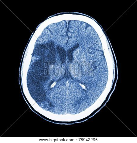 Ct Brain : Show Ischemic Stroke