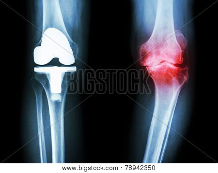 X-ray Knee Of Osteoarthritis Knee Patient And Artificial Joint