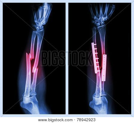 Fracture Both Bone Of Forearm. It Was Operated And Internal Fixed With Plate And Screw