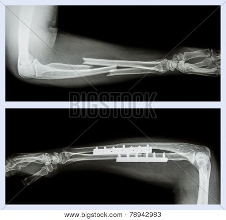 Upper Image : Fracture Ulnar And Radius (forearm Bone) , Lower Image : It Was Operated And Internal