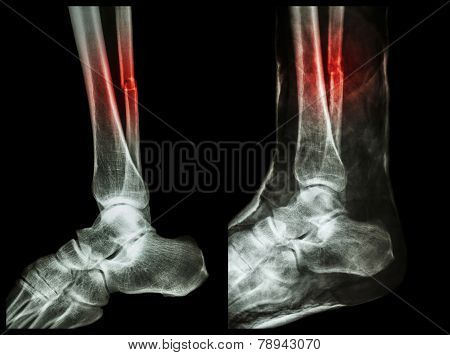 Fracture shaft of fibula (calf bone)