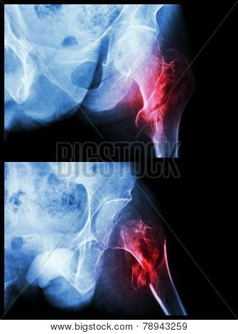Fracture Head Of Femur(thigh Bone) (intertrochanteric Fracture)  (2 Position)