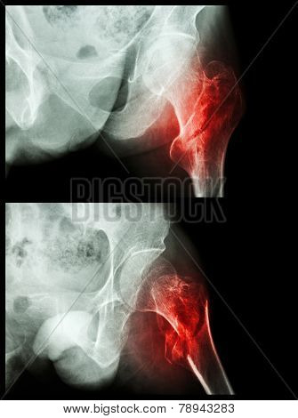 Fracture Head Of Femur(thigh Bone) (intertrochanteric Fracture)  (2 Position)