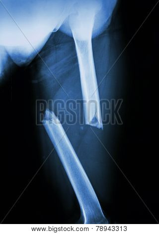 Fracture Femur