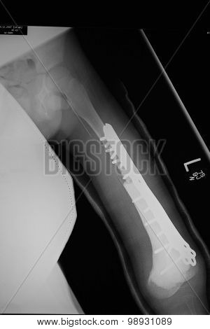 Ostersarcoma Cancer Treatment