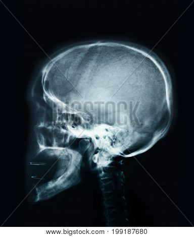 The Human skull X-ray image on black.