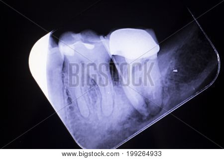 Tooth Crown Root Canal