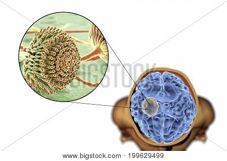 Aspergilloma of the brain and close-up view of fungi Aspergillus, 3D illustration. An intracranial lesion produced by fungi Aspergillus in immunocompromised patients