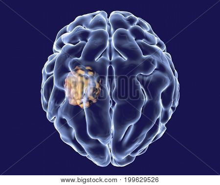 Aspergilloma of the brain, 3D illustration. Also known as mycetoma, or fungus ball, an intracranial lesion produced by fungi Aspergillus in immunocompromised patients