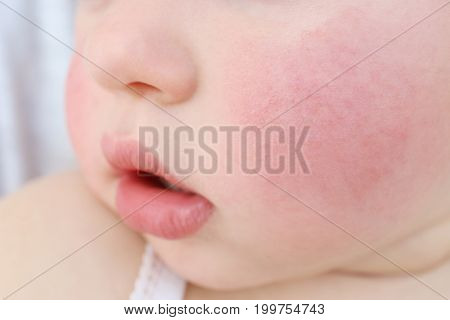 Little child with diathesis symptoms on cheeks, closeup