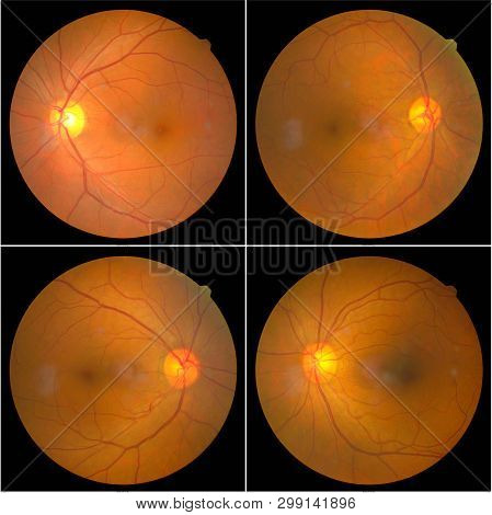 Collection Of Retinal Image  Of The Patient Taken With Retinal Photography Machine.