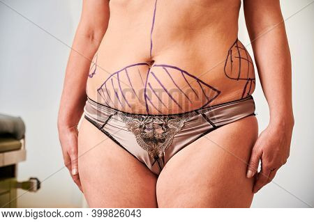Close Up Front View Of Female Patient Belly With Blue Marks. Fat Woman In Underwear Demonstrating Re