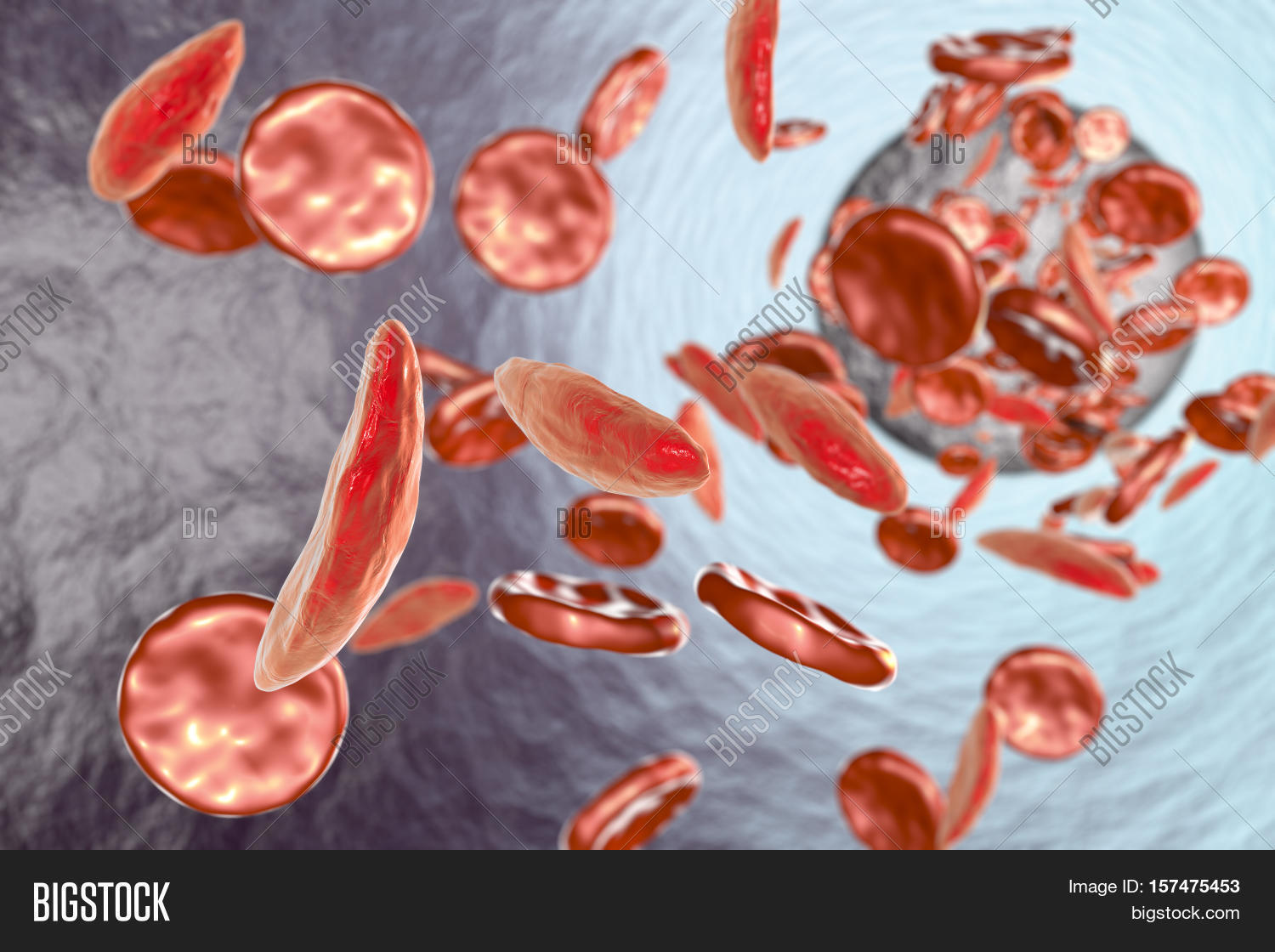sickle cell anemia, 3d illustration showing blood vessel with