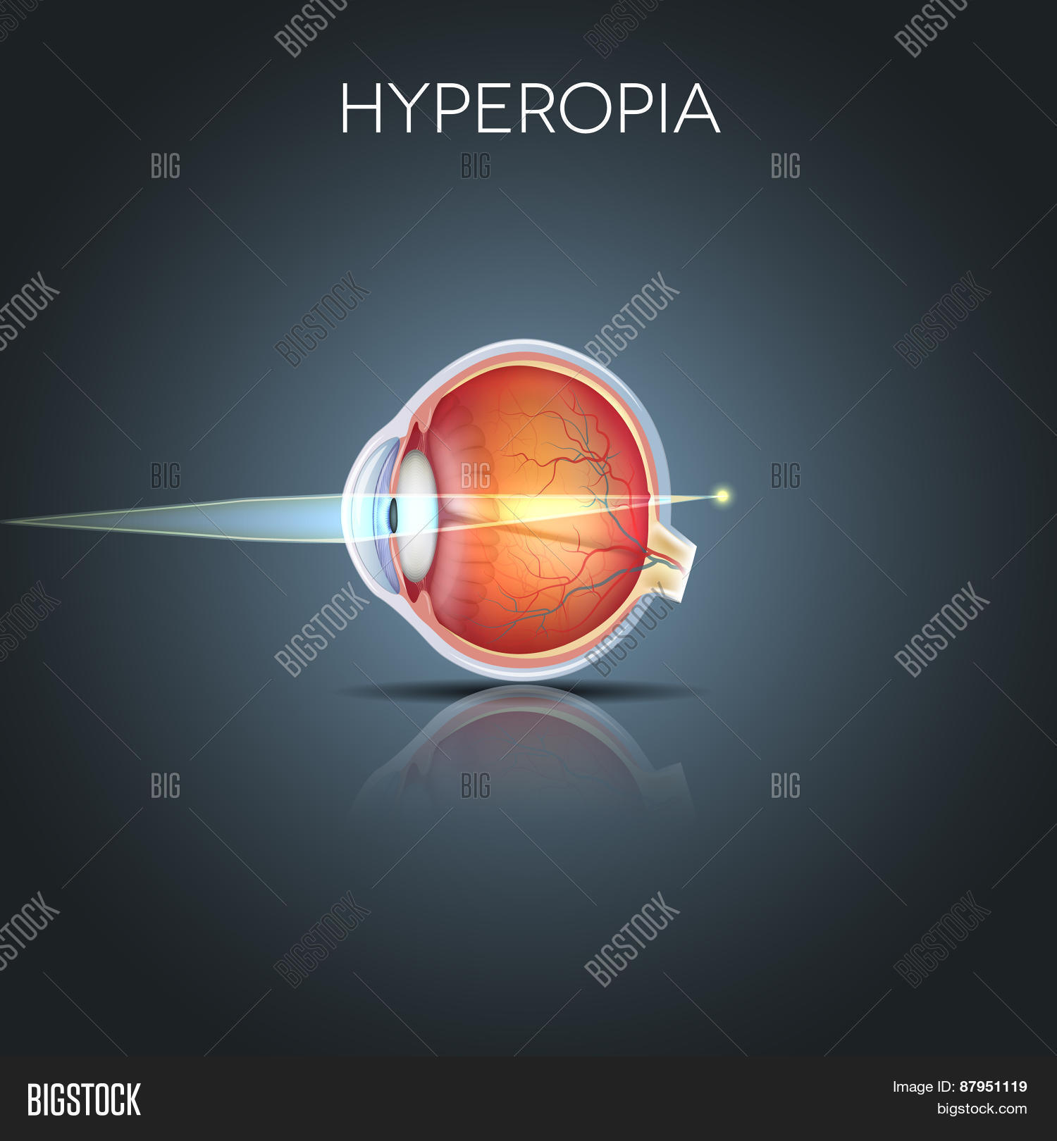 hyperopia 库存矢量图和库存照片 | bigstock